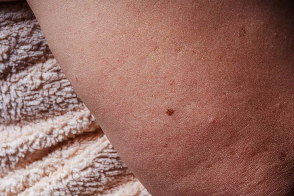 Manchas Edad Lunares Pecas Primer Plano Del Cuerpo Manchas Cuerpo —  Fotos de Stock