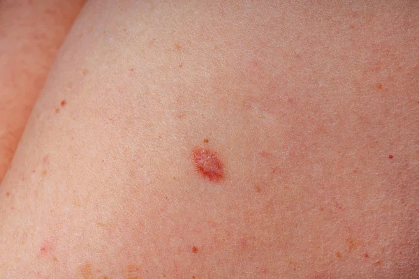Age Spots Moles Freckles Body Close Spots Body Texture Skin — 스톡 사진