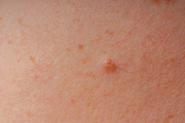 Manchas Edad Lunares Pecas Primer Plano Del Cuerpo Manchas Cuerpo — Foto de Stock