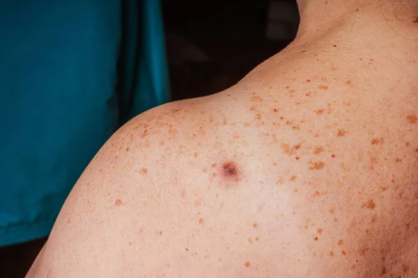 Age Spots Moles Freckles Shoulders Back Older Woman Pigmentation Shoulder — Stock Photo, Image