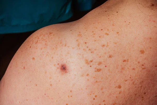Age Spots Moles Freckles Shoulders Back Older Woman Pigmentation Shoulder — Stockfoto