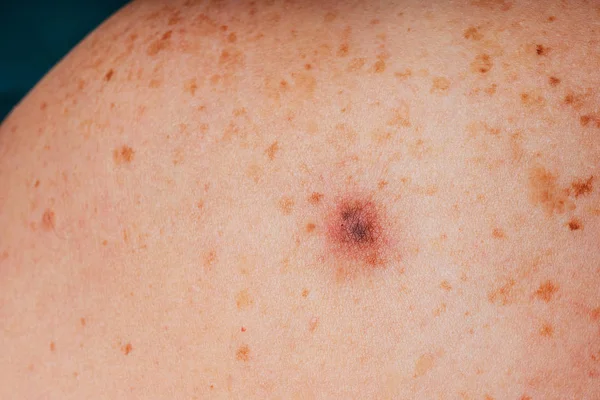 Age Spots Moles Freckles Body Close Spots Body Texture Skin — ストック写真