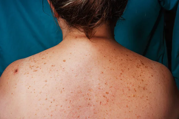 Age spots, moles, and freckles on the back of an older woman. Pigmentation on the back. Spots on the body