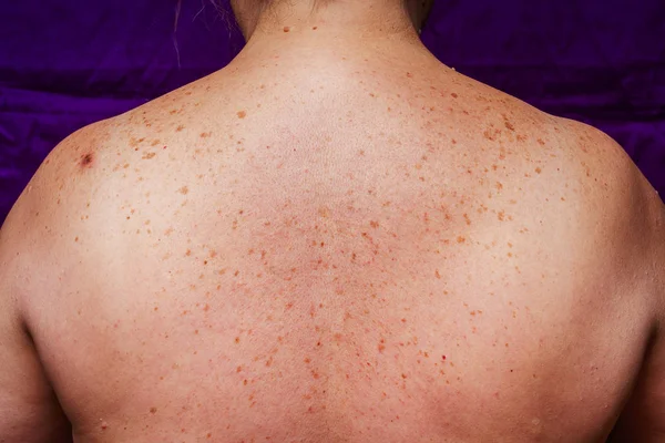 Manchas Edad Lunares Pecas Espalda Una Mujer Mayor Pigmentación Espalda —  Fotos de Stock