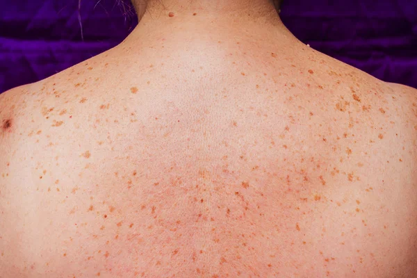 Manchas Edad Lunares Pecas Espalda Una Mujer Mayor Pigmentación Espalda —  Fotos de Stock