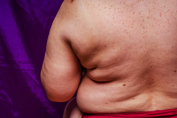 Age spots, moles, and freckles on the back of an older woman. Pigmentation on the back. Spots on the body. Fat folds on the sides of the body. Overweight in middle-aged women