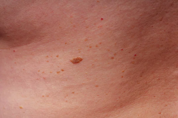 Kor Foltok Anyajegyek Szeplők Testen Közelről Foltok Testen Textúra Bőr — Stock Fotó