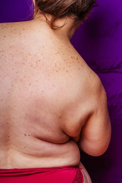 Age spots, moles, and freckles on the back of an older woman. Pigmentation on the back. Spots on the body. Fat folds on the sides of the body. Overweight in middle-aged women
