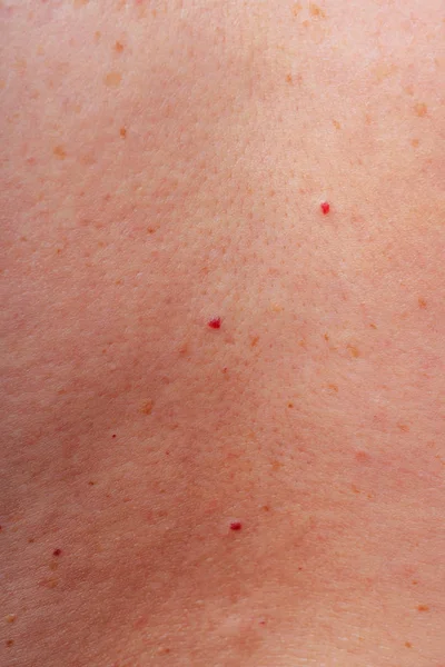 Age Spots Moles Freckles Body Close Spots Body Texture Skin — Stock Photo, Image