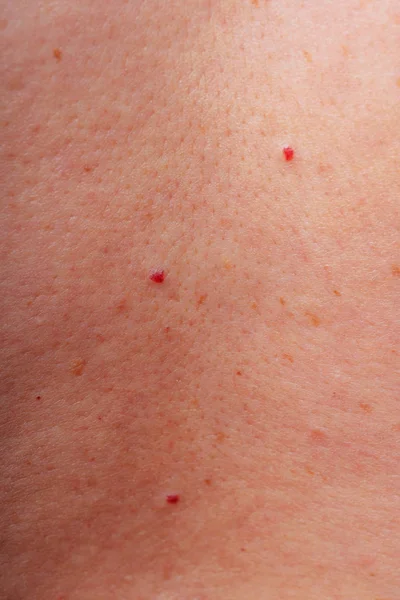 Kor Foltok Anyajegyek Szeplők Testen Közelről Foltok Testen Textúra Bőr — Stock Fotó