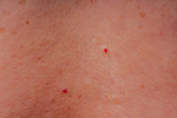 Age Spots Moles Freckles Body Close Spots Body Texture Skin — Stock Photo, Image