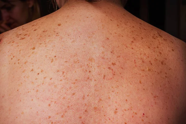 Manchas Edad Lunares Pecas Espalda Una Mujer Mayor Pigmentación Espalda —  Fotos de Stock