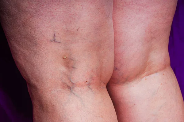 Varicose veins on a woman's legs. Initial stage of varicose veins. Blue veins on white skin on the legs of an aged woman in close-up.