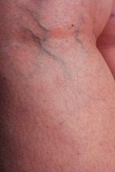 Varicose veins on a woman\'s legs. Initial stage of varicose veins. Blue veins on white skin on the legs of an aged woman in close-up.