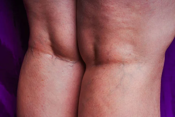 Varicose veins on a woman\'s legs. Initial stage of varicose veins. Blue veins on white skin on the legs of an aged woman in close-up.