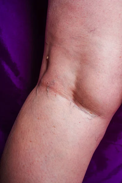 Varicose veins on a woman's legs. Initial stage of varicose veins. Blue veins on white skin on the legs of an aged woman in close-up.