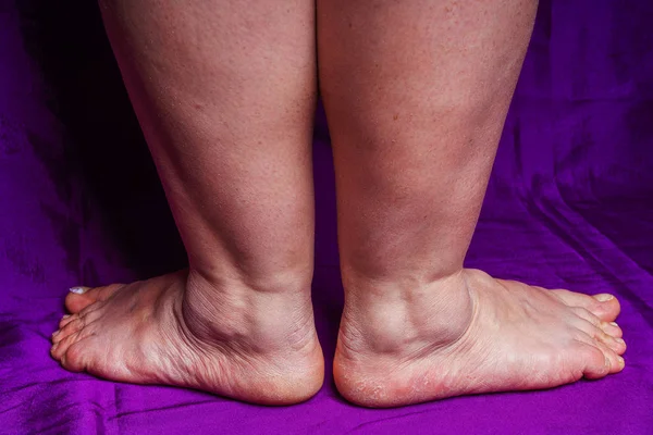 Ayağındaki Deri Alerjisi Kızarıklığı Yaşlı Kadının Bacakları Kadın Ayağının Topuklarında — Stok fotoğraf