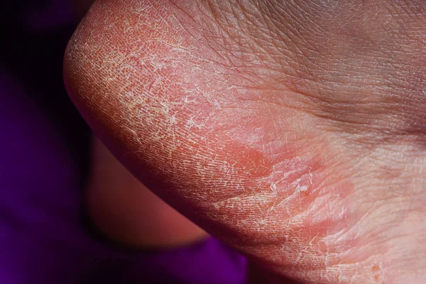 Dermatitis Alérgica Cutánea Enrojecimiento Pie Las Piernas Una Anciana Grietas —  Fotos de Stock