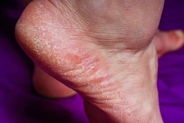 足の皮膚アレルギー性皮膚炎の発赤 老婦人の足女性の足のかかとに亀裂 かかとに皮が割れています 足の皮膚の問題 — ストック写真