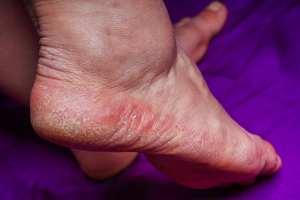 Skin allergic dermatitis redness on the foot. Old woman\'s legs. Cracks in the heels of women\'s feet.  Cracked skin on the heels. Problems with the skin of the feet