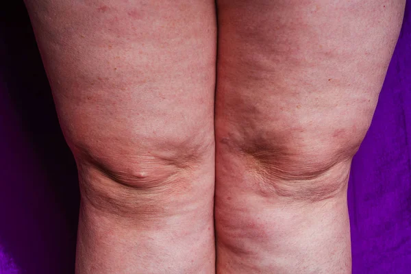 膝の炎症 老婦人の足女性の足のセルライト — ストック写真