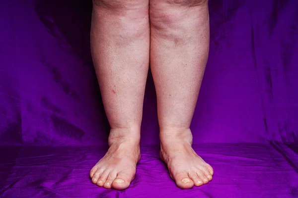 Tırnaklarında Mantar Olan Ayaklar Düzensiz Ayak Tırnakları Yaşlı Kadının Bacakları — Stok fotoğraf