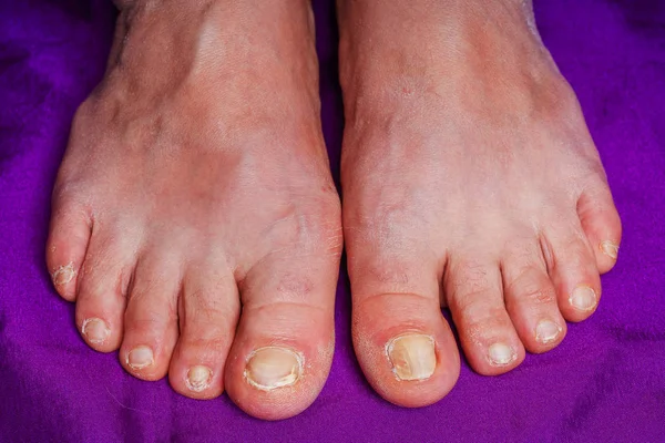 Feet with fungus on the nails. Untidy toenails. Old woman\'s legs. Feet of an aged woman.