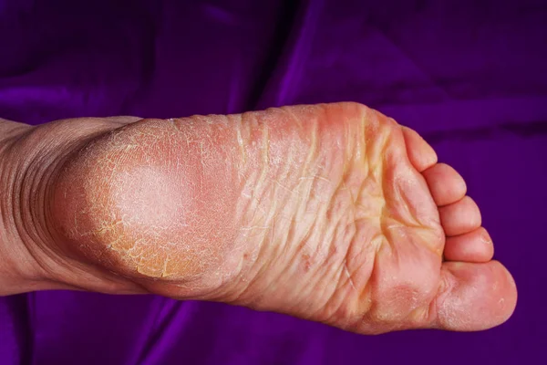 Cracks in the heels of women\'s feet.  Dry, cracked skin on the heels. Problems with the skin of the feet