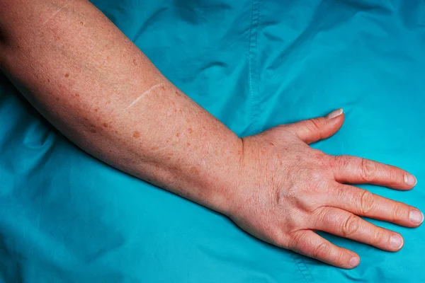 Old scars on an elderly woman\'s body. Scars and marks from a car crash. Traces of deep cuts and scratches