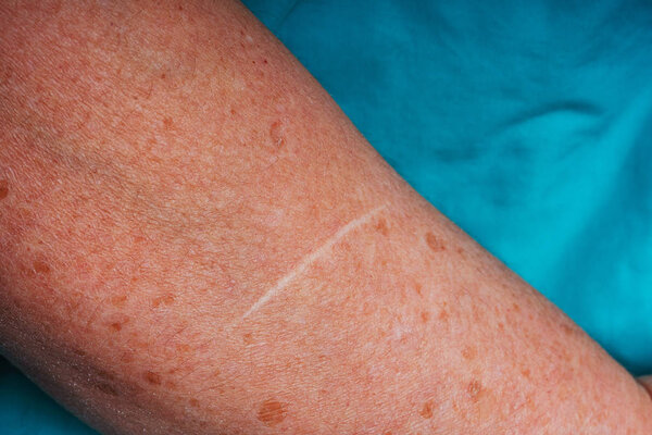 Old scars on an elderly woman's body. Scars and marks from a car crash. Traces of deep cuts and scratches