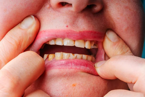 Woman without teeth mouth close-up. Preparation of teeth turning for the installation of a ceramic crown. Unhealthy teeth in an elderly woman.