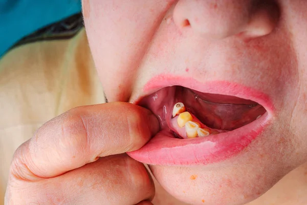 Woman without teeth mouth close-up. Preparation of teeth turning for the installation of a ceramic crown. Unhealthy teeth in an elderly woman.