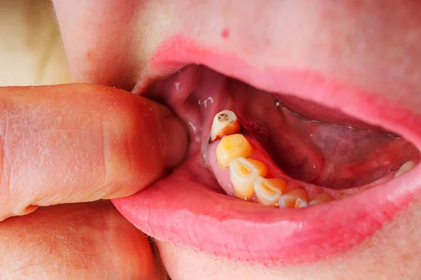 Woman without teeth mouth close-up. Preparation of teeth turning for the installation of a ceramic crown. Unhealthy teeth in an elderly woman.