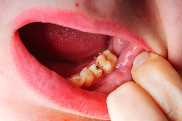 Mujer Sin Dientes Boca Cerca Preparación Torneado Dientes Para Instalación — Foto de Stock