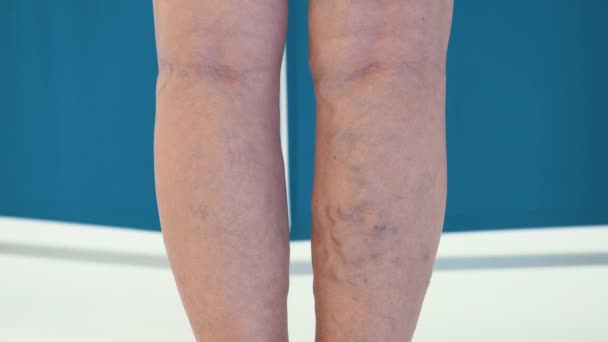 クローズアップで高齢女性の静脈瘤の検査 静脈瘤の女性の足の静脈 放置された状態の老婦人の静脈 — ストック動画