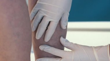 Yaşlı bir kadında varisli damarların yakından incelenmesi. Eldivenli bir doktor varisli bir kadının bacaklarındaki damarları inceler. İhmal edilmiş yaşlı bir kadında varisli damarlar.