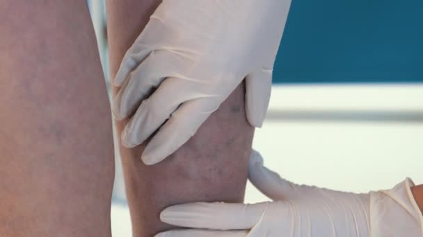 クローズアップで高齢女性の静脈瘤の検査 手袋の医者は静脈瘤の女性の足の静脈を調べる 放置された状態の老婦人の静脈 — ストック動画