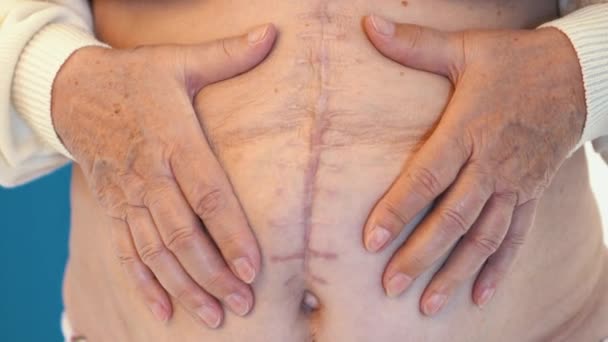 Exame Sutura Corpo Mulher Após Cirurgia Cicatriz Após Cirurgia Grande — Vídeo de Stock