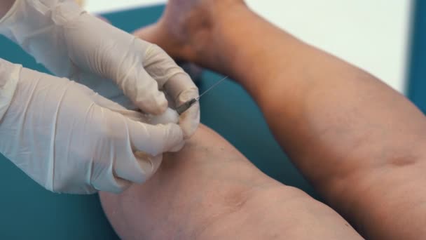 Behandeling Van Spataderen Met Injecties Een Injectie Een Ader Het — Stockvideo