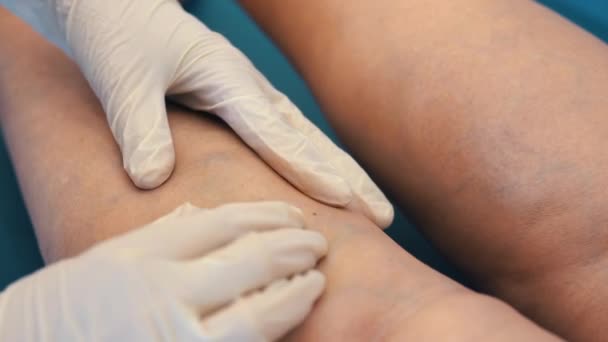 Examen Des Varices Chez Une Femme Âgée Gros Plan Médecin — Video