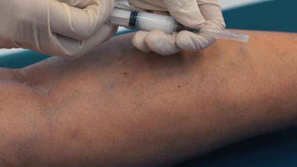 Varisli Damarların Enjeksiyonla Tedavi Edilmesi Bacağındaki Damara Enjekte Edilmiş Bacaklarda — Stok video