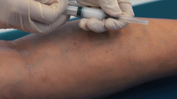 Behandeling Van Spataderen Met Injecties Een Injectie Een Ader Het — Stockvideo