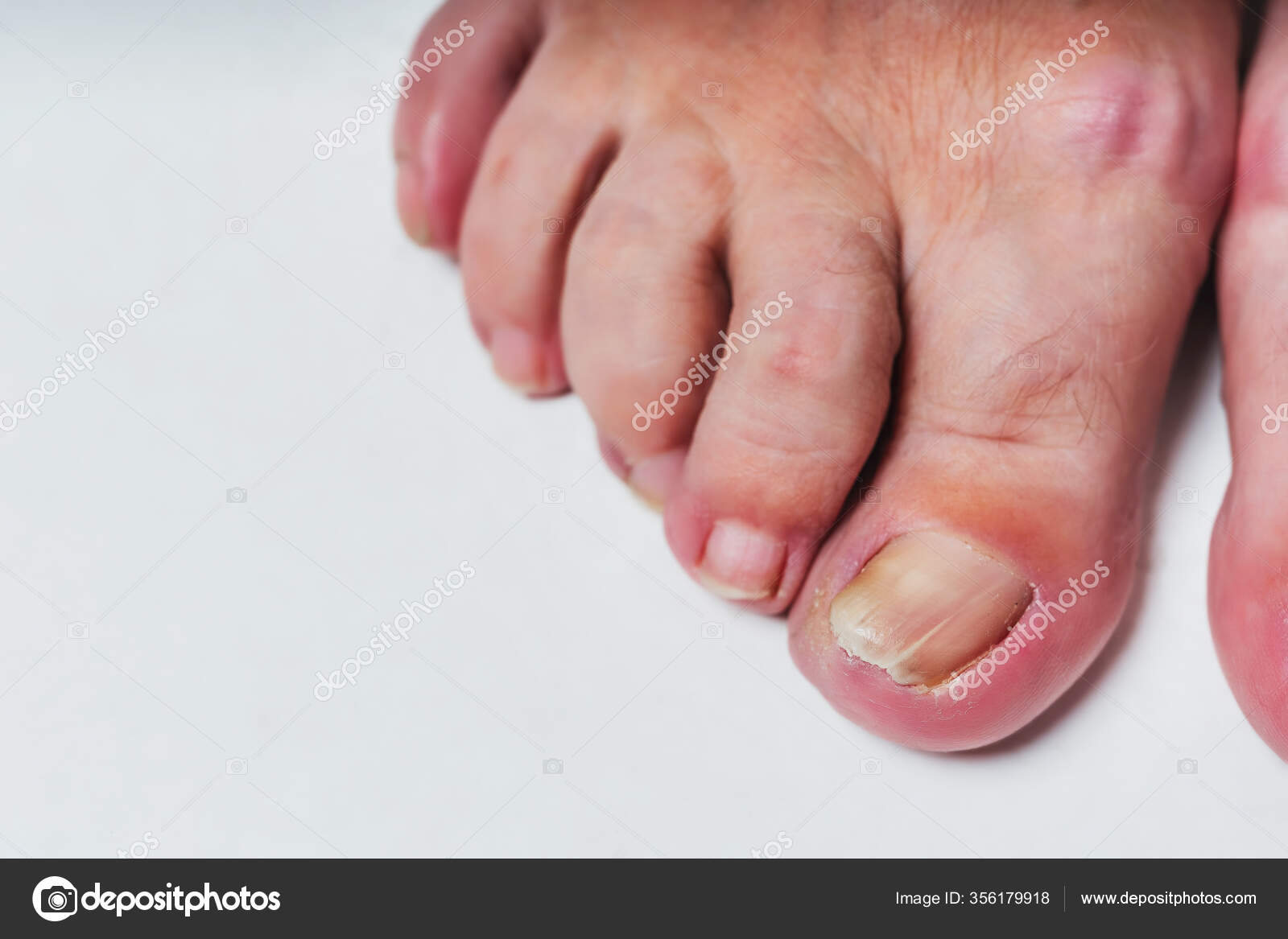 Nail Fungus Toes Elderly Woman's Feet Close White Background Old