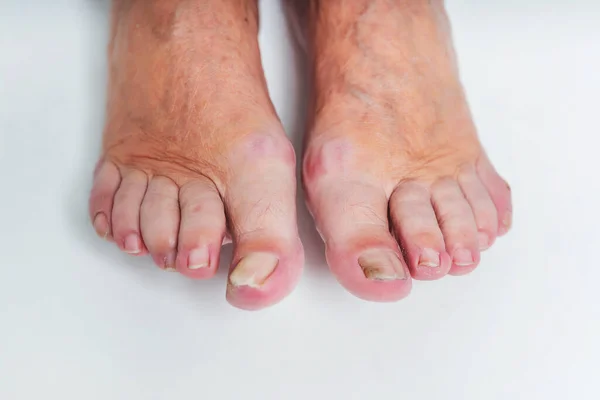 Nail fungus on the toes of an elderly woman\'s feet close-up on a white background.  The old woman\'s unkempt toenails. Calluses and sores on the feet