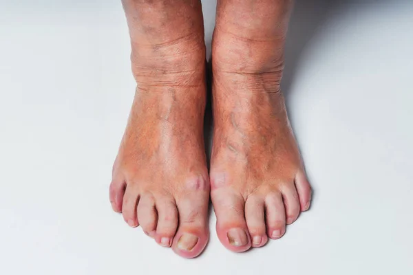 Nail fungus on the toes of an elderly woman\'s feet close-up on a white background.  The old woman\'s unkempt toenails. Calluses and sores on the feet