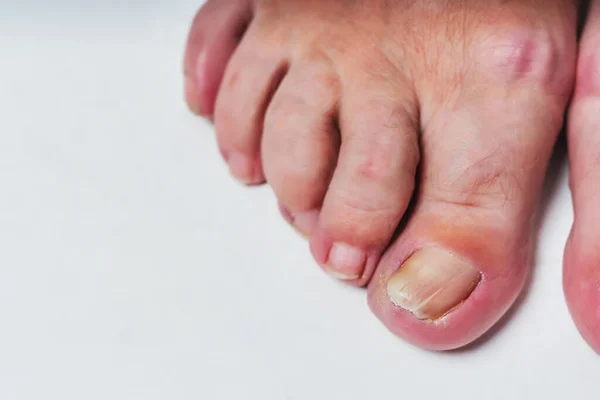 Nail fungus on the toes of an elderly woman's feet close-up on a white background.  The old woman's unkempt toenails. Calluses and sores on the feet