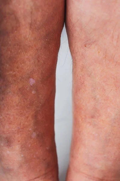 Varicose veins in an elderly woman. Inflamed dilated veins in the legs. Varicose veins in the late advanced stage.