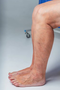Varicose veins in an elderly woman. Inflamed dilated veins in the legs. Varicose veins in the late advanced stage. clipart