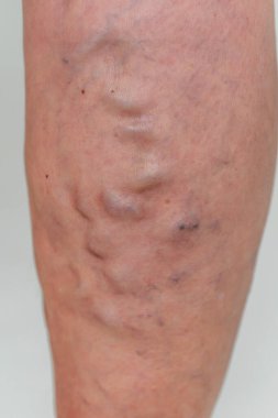 Varicose veins in an elderly woman. Inflamed dilated veins in the legs. Varicose veins in the late advanced stage. clipart
