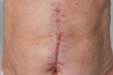 Yaşlı bir kadının gövdesinde ameliyat sonrası yara izi. Safra kesesi alındıktan sonra yara izi. Ameliyattan sonra karın bölgesindeki dikişler.